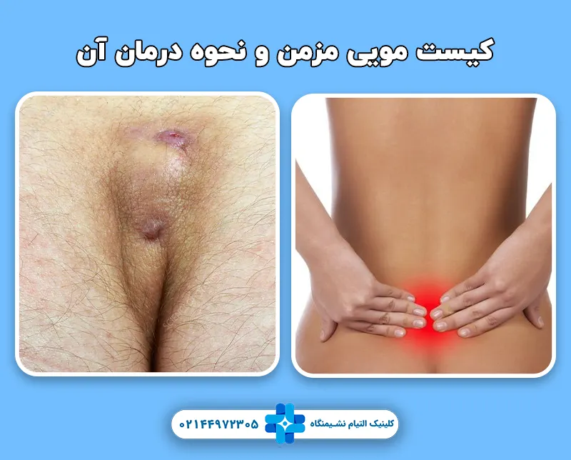 کیست مویی مزمن