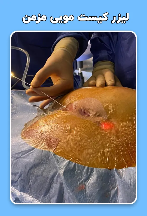 لیزر کیست‌ مویی مزمن