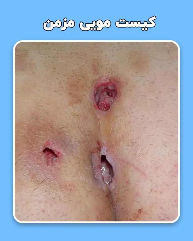 کیست‌ مویی مزمن