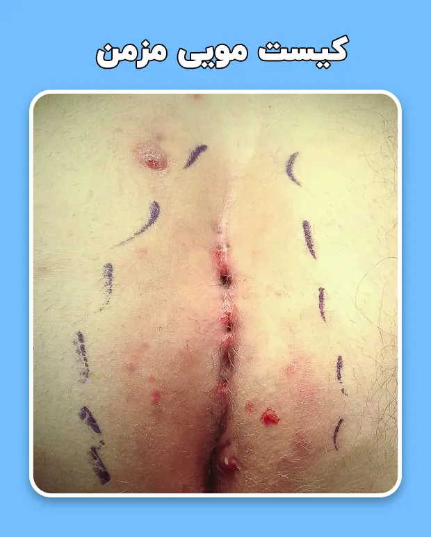 کیست مویی مزمن