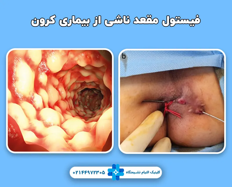 فیستول مقعد ناشی از بیماری کرون