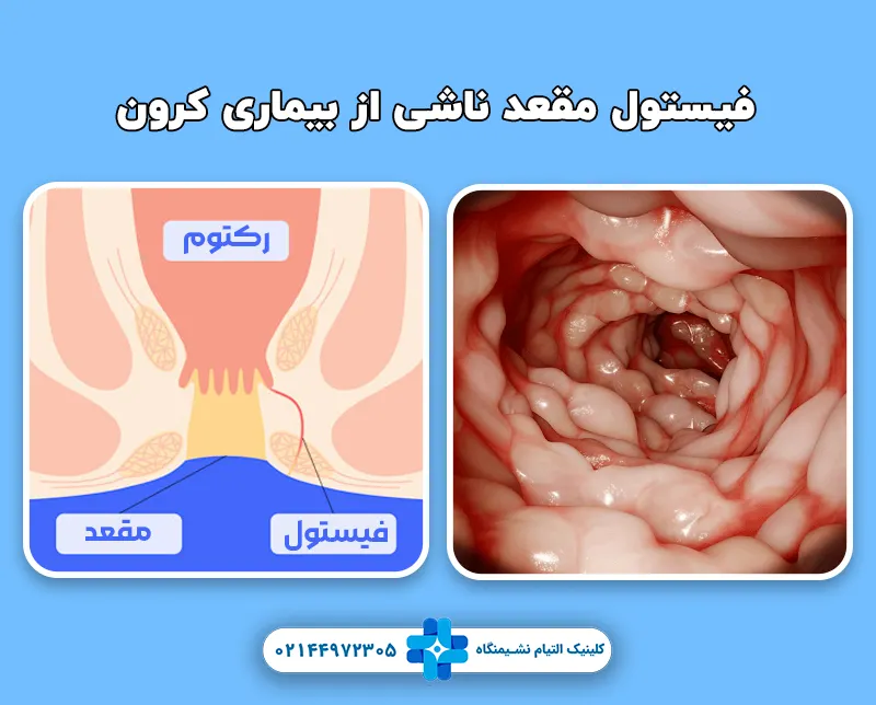 فیستول مقعد ناشی از بیماری کرون