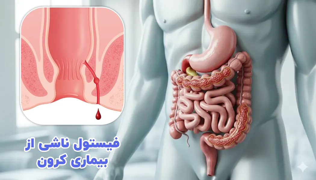فیستول مقعد ناشی از بیماری کرون