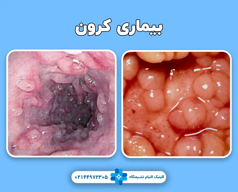 بیماری کرون