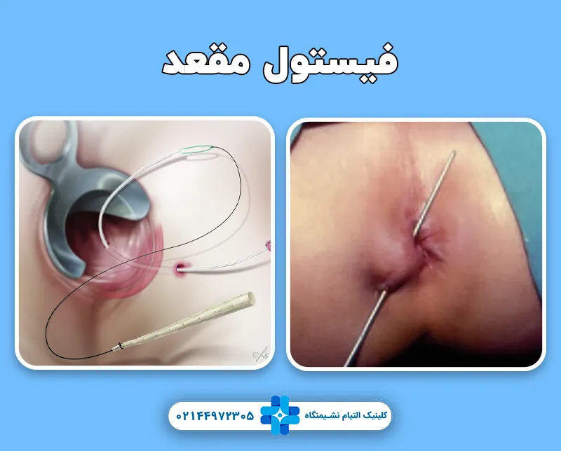 فیستول مقعد