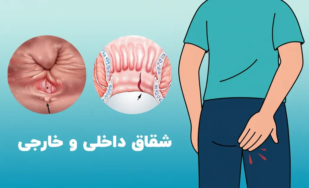 شقاق داخلی و خارجی و نحوه درمان آن