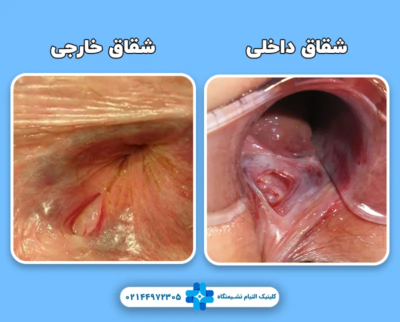 تفاوت‌ شقاق داخلی و خارجی