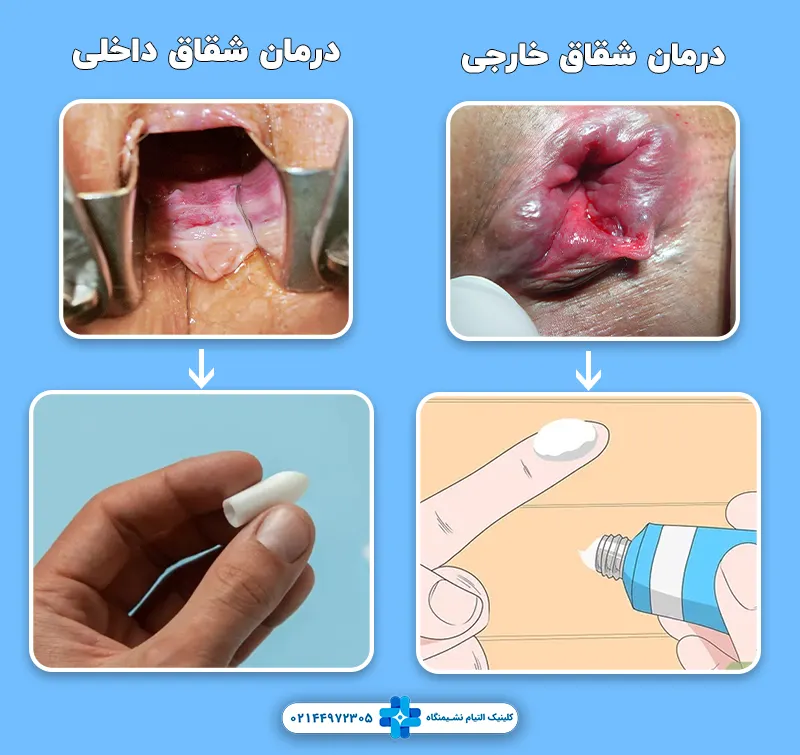 نحوه درمان شقاق داخلی و خارجی