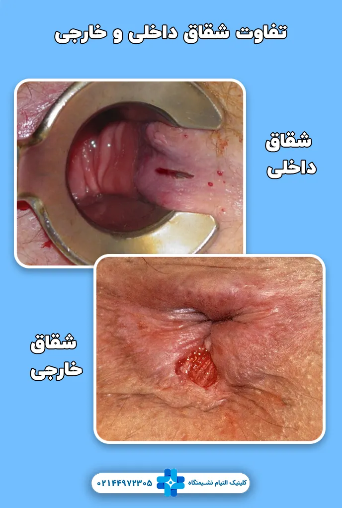 تفاوت‌ شقاق داخلی و خارجی