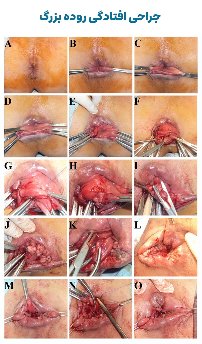 مراحل جراحی افتادگی روده بزرگ