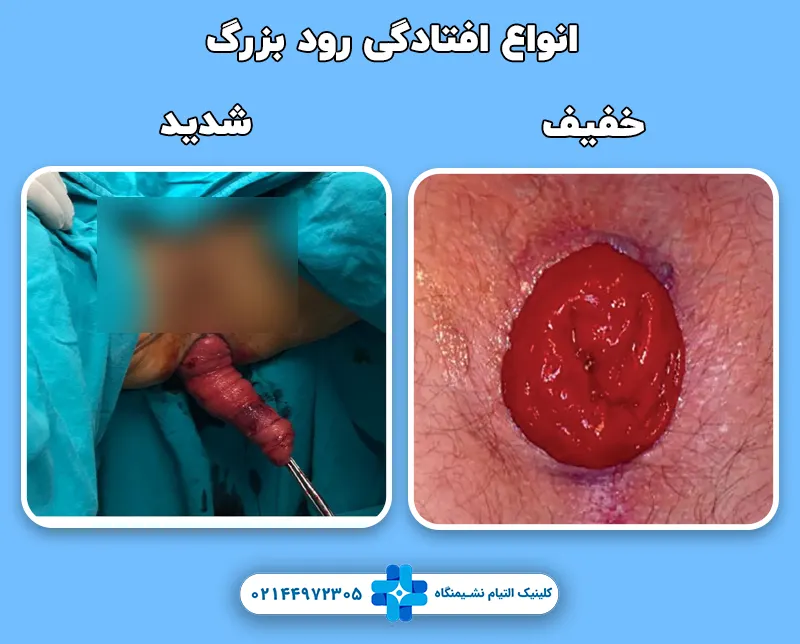 انواع افتادگی روده بزرگ