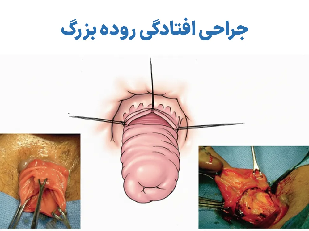 درمان افتادگی روده بزرگ