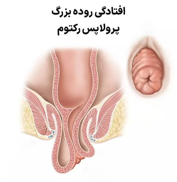 افتادگی روده بزرگ