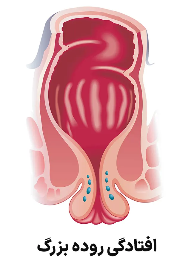 افتادگی روده بزرگ