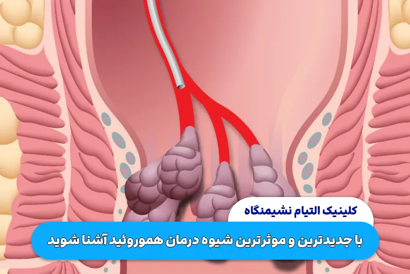 آمبولیزاسیون هموروئید