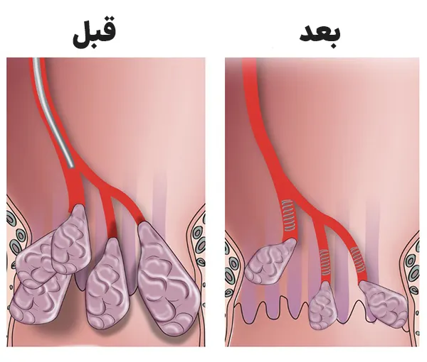 آمبولیزاسیون هموروئید