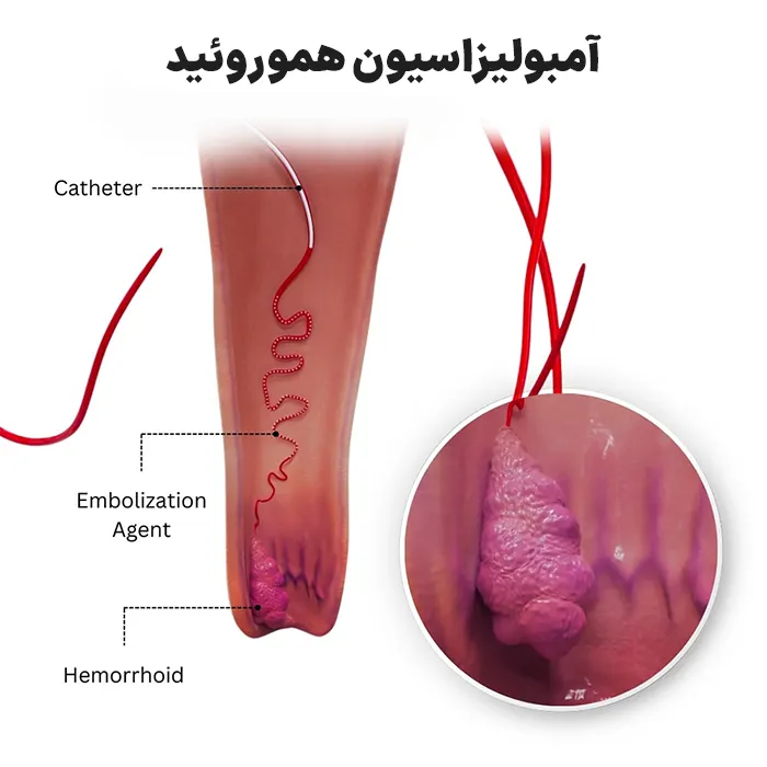 آمبولیزاسیون هموروئید