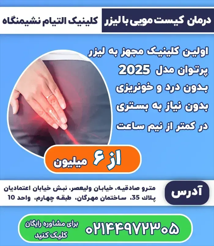 درمان کیست مویی با لیزر