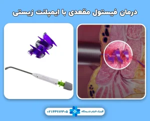 درمان فیستول با ایمپلنت BioHealx