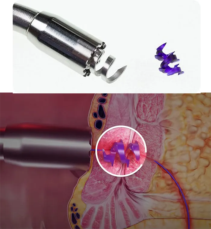 درمان فیستول با ایمپلنت BioHealx