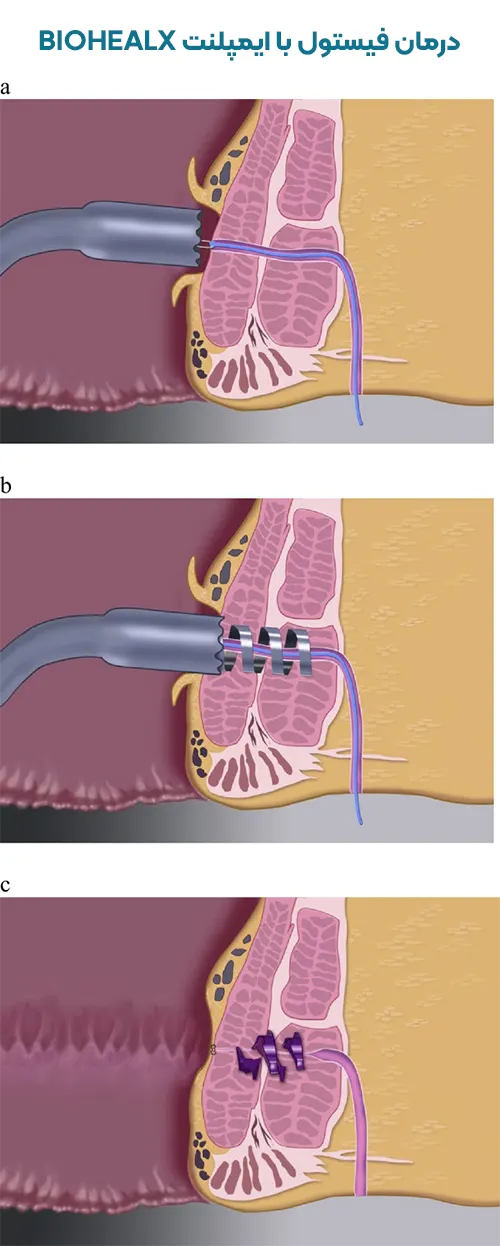 مراحل روش BAFT فیستول مقعد