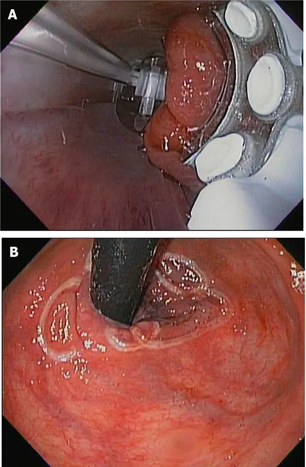 درمان هموروئید داخلی با انرژی حرارتی