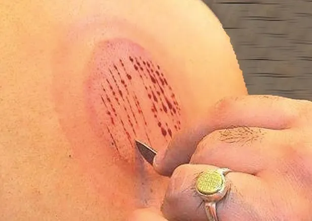 حجامت برای درمان هموروئید