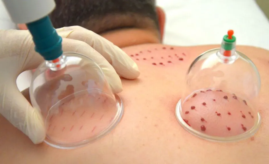 حجامت برای درمان هموروئید