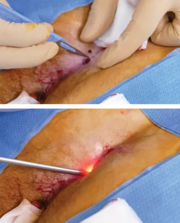 رلیزر کیست مویی