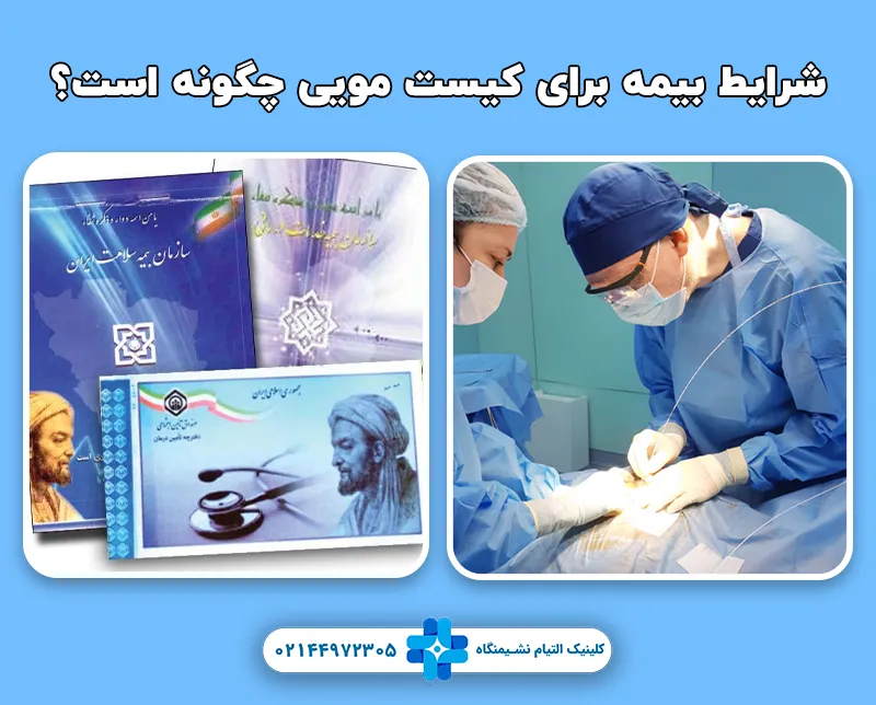 شرایط بیمه برای لیزر کیست مویی چگونه است؟