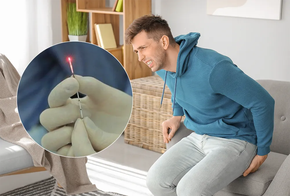 لیزر کیست مویی