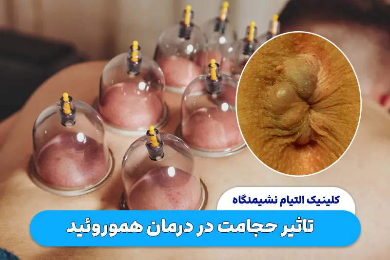 تاثیر حجامت در درمان هموروئید