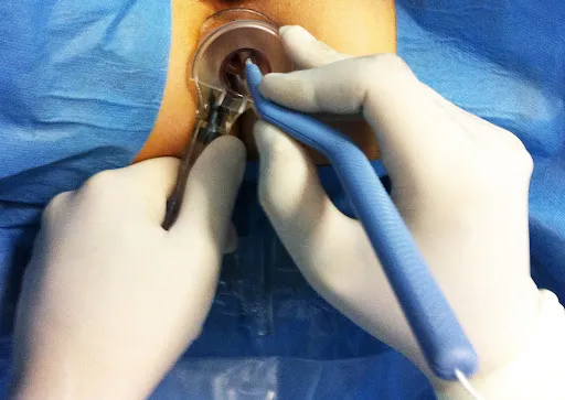 لیزر بواسیر