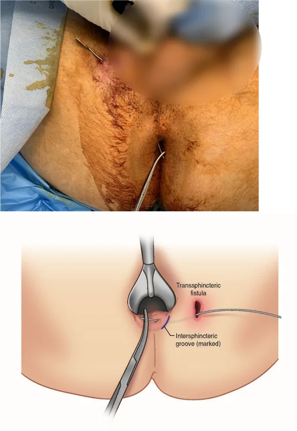 درمان فیستول مقعد به روش TROPIS