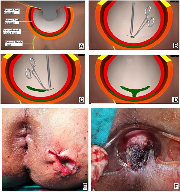 درمان فیستول مقعد به روش TROPIS