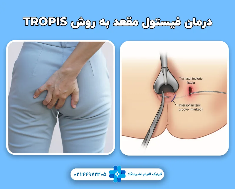 درمان فیستول مقعد به روش TROPIS