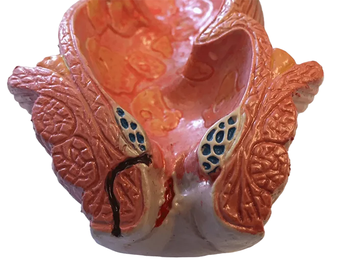 فیستول مقعد