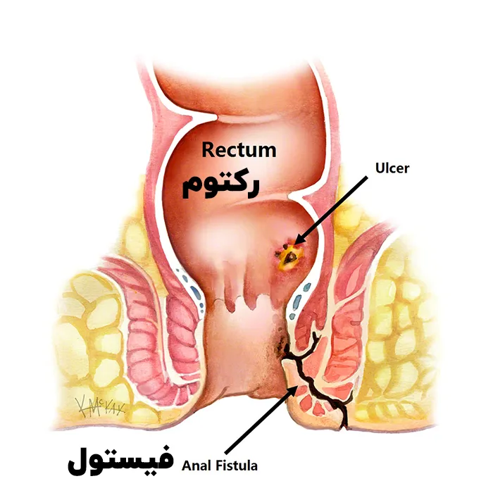 فیستول مقعد
