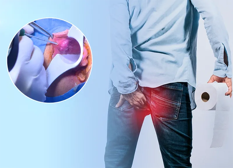 درمان هموروئید و شقاق با لیزر