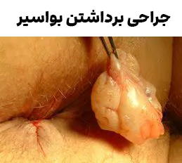 جراحی برداشتن هموروئید