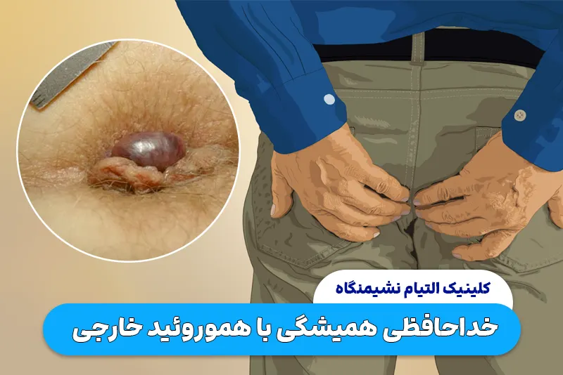 خداحافظی همیشگی با هموروئید خارجی با این روش ها