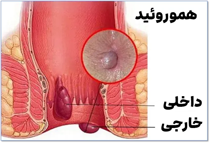 هموروئید خارجی