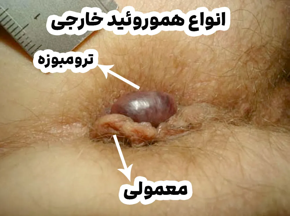 انواع هموروئید خارجی