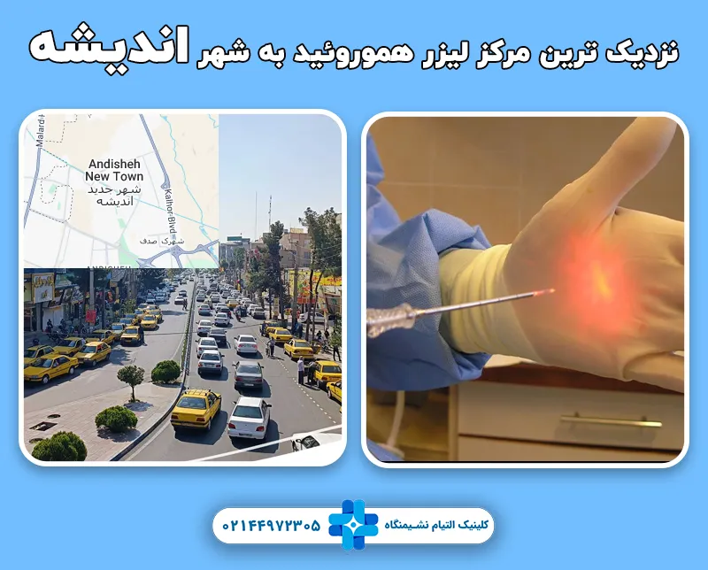 لیزر هموروئید در شهر اندیشه