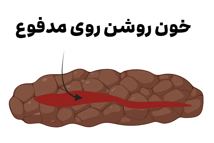 دلیل خون روشن روی مدفوع