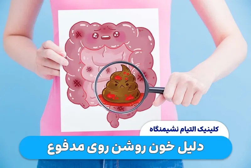 دلیل خون روشن روی مدفوع