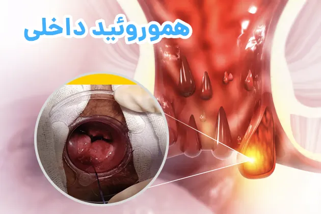 هموروئید داخلی