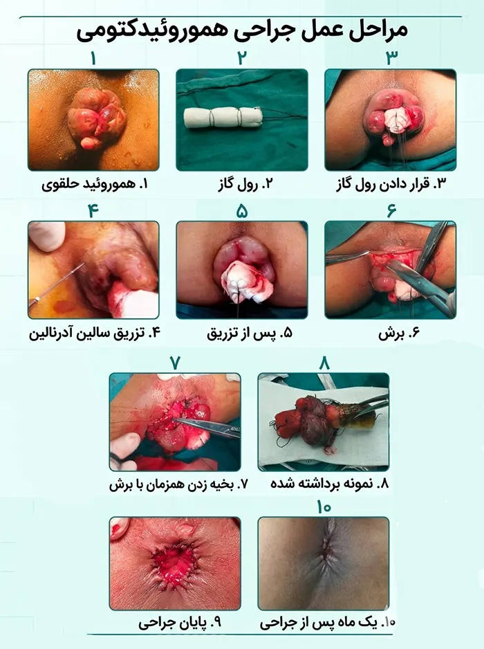 هموروئیدکتومی