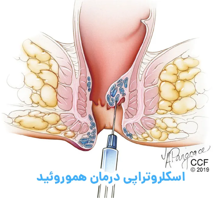 اسکلروتراپی