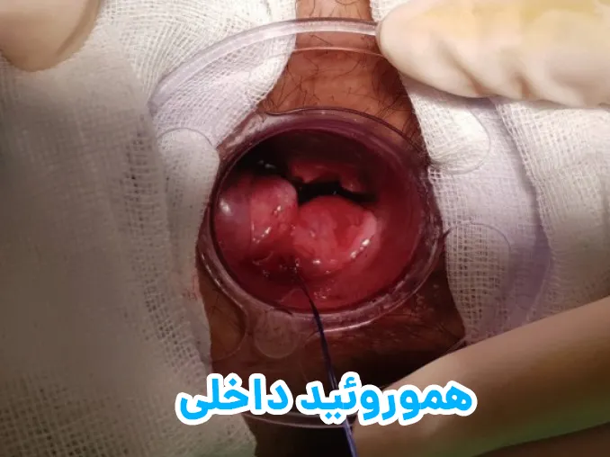هموروئید داخلی